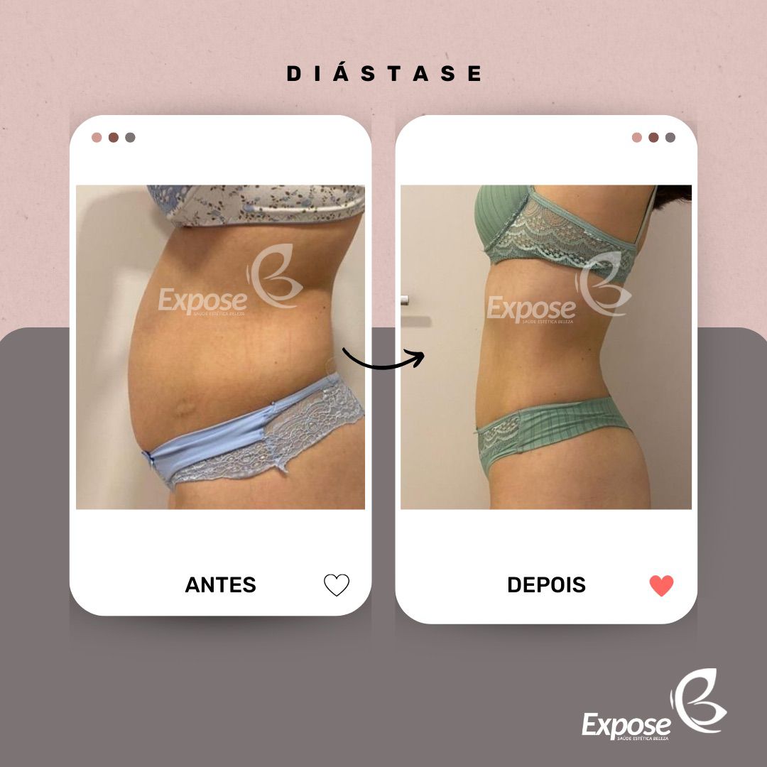 Resultado real do protocolo EXPODIÁSTASE — Paciente Expose · vista lateral