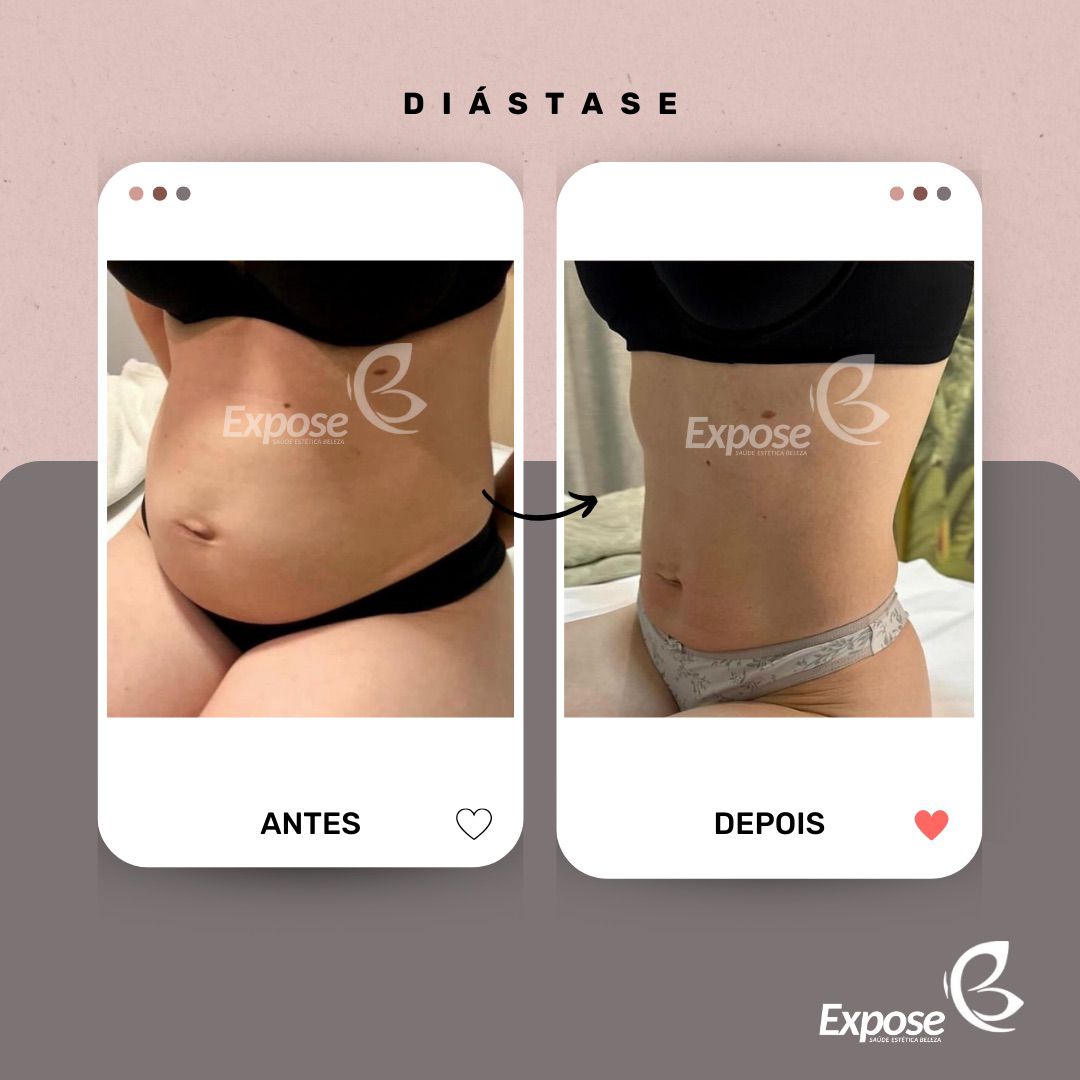Resultado real do protocolo EXPODIÁSTASE — Paciente Expose · vista frontal